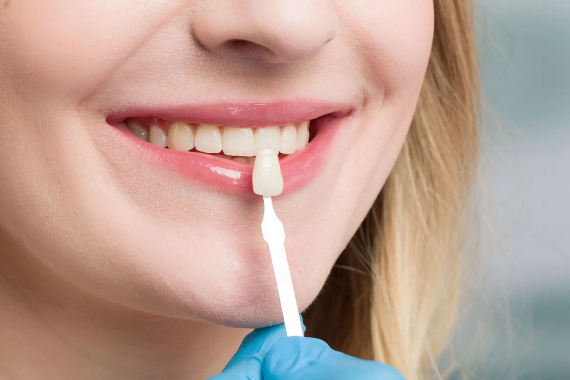 Dental crown restoration