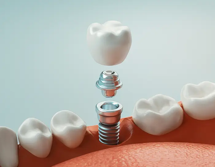 dental implants (2)