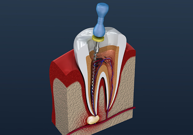 Understanding endodontic treatment
